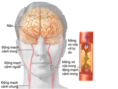 Các mảng xơ vữa trong động mạch gây nên tình trạng thiếu máu lên não
