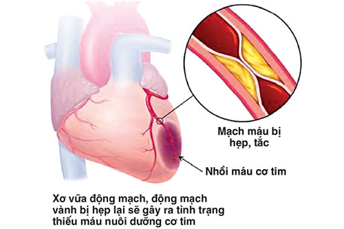 Thiếu máu cơ tim có thể dẫn đến tình trạng hoại tử 