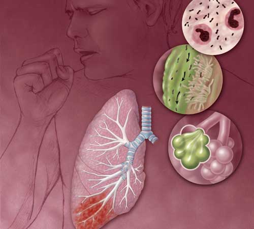 Nhiều nguyên nhân gây bệnh viêm phổi mắc phải tại cộng đồng