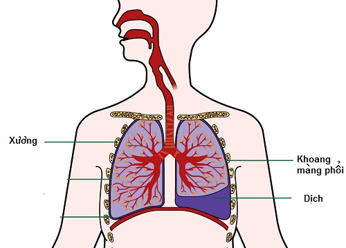 Triệu chứng và nguyên nhân của bệnh xẹp phổi là gì?