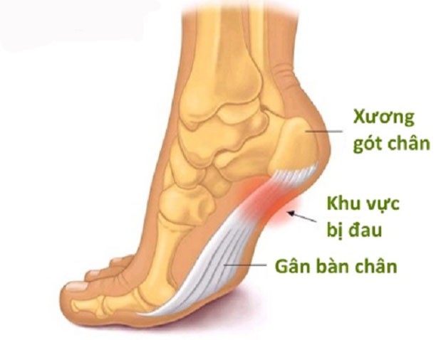 Cách chữa đau gót chân bằng nguyên liệu tự nhiên tại nhà