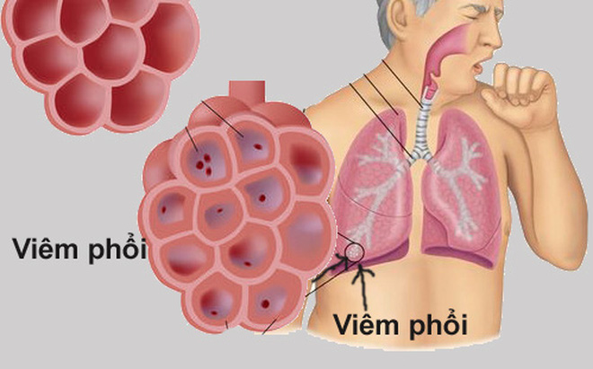 Bệnh viêm phổi của người trưởng thành là gì?