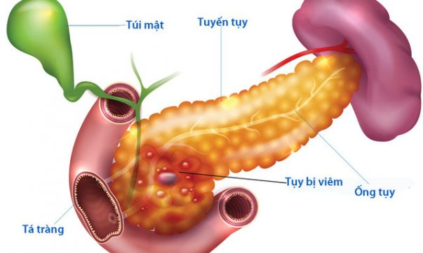 Phương pháp điều trị bệnh viêm tụy cấp hiệu quả