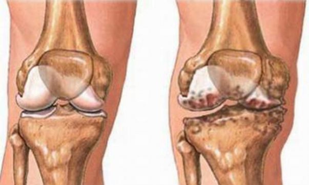 Bác sĩ tư vấn: Khi nào bệnh nhân nên mổ thay khớp gối?