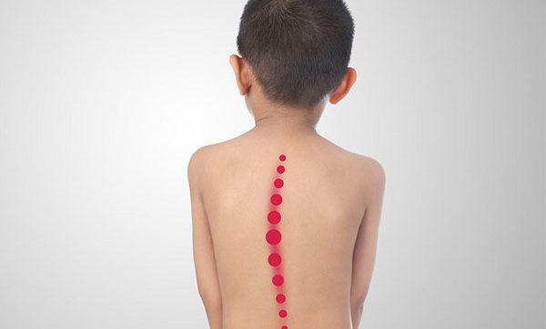Tìm hiểu chứng cong vẹo cột sống ở trẻ em