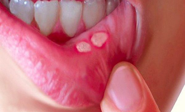 8 tuyệt chiêu đánh bay nhiệt miệng “thần tốc” ngay tại nhà