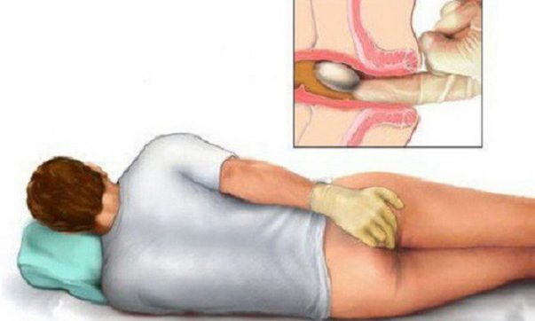 Những loại thực phẩm nên và không nên ăn đối với bệnh nhân bị trĩ
