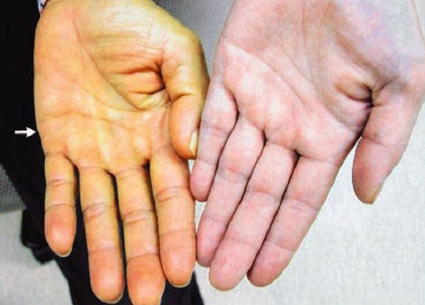 Tình trạng tăng chất Bilirubin (sắc tố mật) trong máu là vấn đề gây ra hiện tượng vàng da