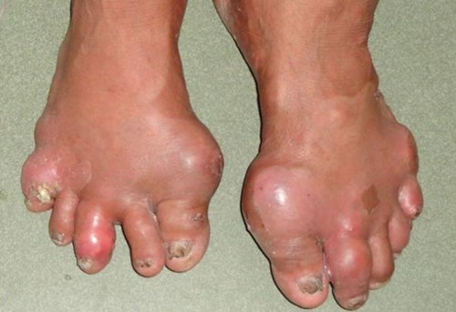 tổng hợp những biến chứng không thể lường trước của bệnh gout