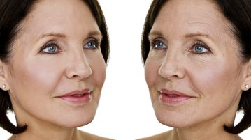 Căng da mặt nội soi giúp bạn lấy lại nét thanh xuân