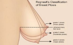 Ngực chảy xệ có nhiều mức độ khác nhau