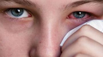 Những cách phòng bệnh đau mắt đỏ hiệu quả
