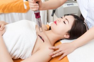 Xóa hình xăm bằng Laser là phương pháp hiệu quả nhất hiện nay