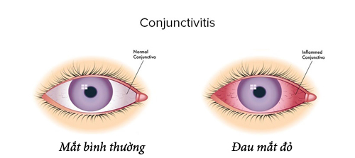 Nhận biết và cách phòng bệnh đau mắt đỏ