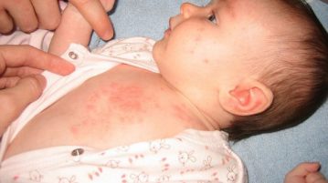 Cha mẹ phải làm gì khi con bị bệnh sốt phát ban?