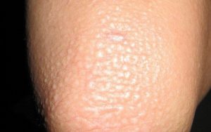 Thoái hóa nhầy là căn bệnh rối loạn chuyển hóa chất nhầy ở da