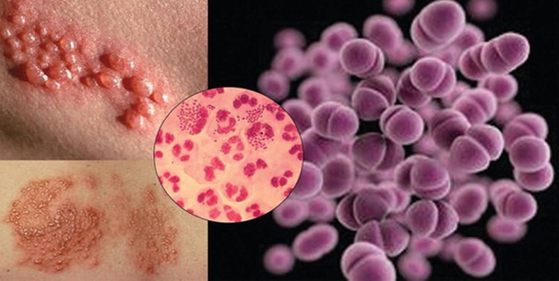 Triệu chứng của u hạt bẹn hoa liễu là gì?