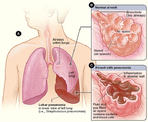Các dạng bệnh viêm phổi nào thường gặp nhất?
