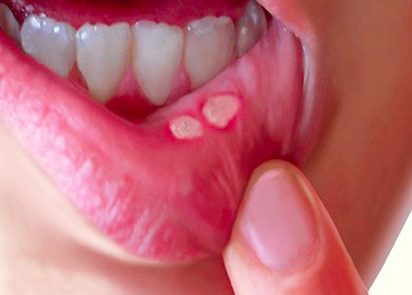 Nhiệt miệng gây ra không ít bất tiện trong lúc ăn uống